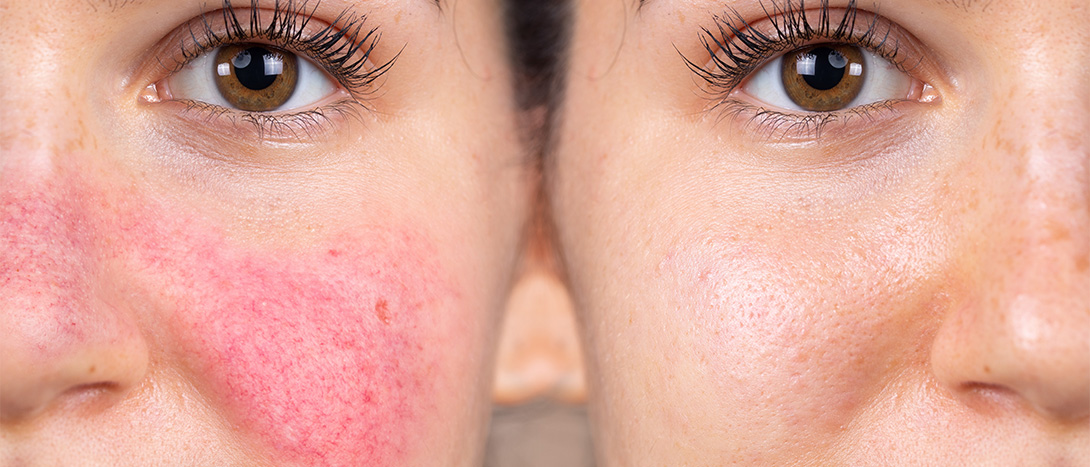 demonstração de rosácea no rosto